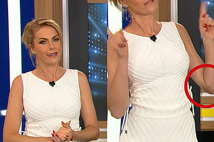 Ana Hickmann mostra braço com ronchas e machucado
