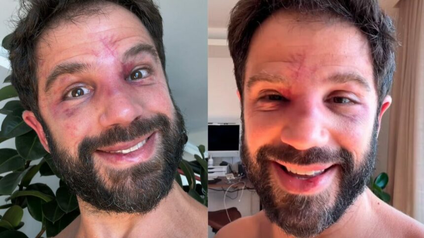 Duda Nagle sorrindo e mostrando hematomas