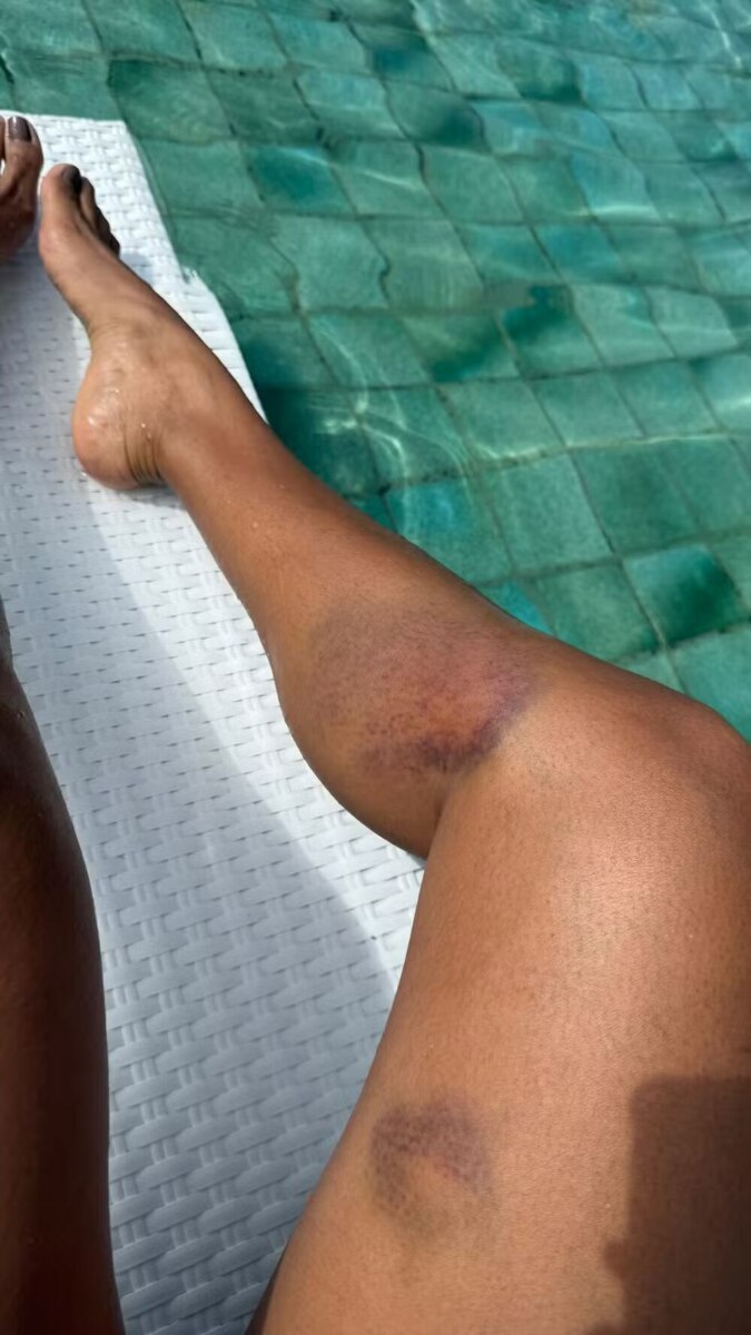 Sheron Menezzes mostrando hematomas na perna após acidente de bicicleta 