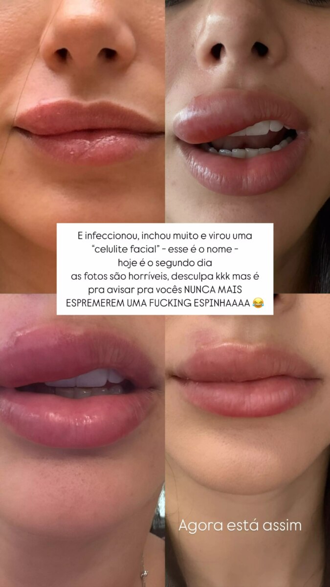 Bruna Biancardi mostrando o lábio inchado por celulite facial em quatro fotos nos stories do Instagram 