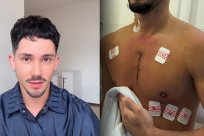 Vittor Fernando de camisa azul antes do ataque no Rio de Janeiro e depois, com uma cicatrix no peito após o atentado