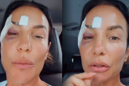 Ivete Sangalo com machucados no rosto após receber alta do hospital