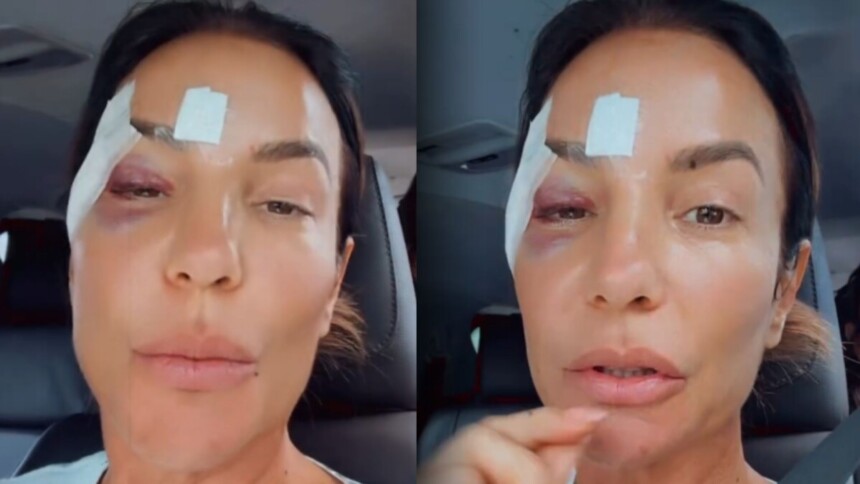 Ivete Sangalo com machucados no rosto após receber alta do hospital