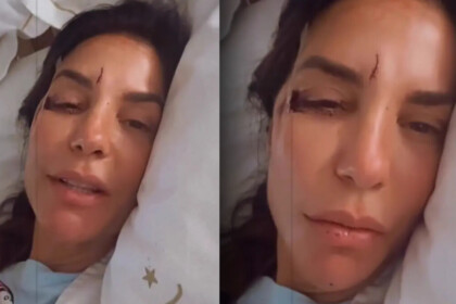 Ivete Sangalo deitada na maca de um hospital com o rosto apresentando machucões na lateral do olho esquerdo e na testa