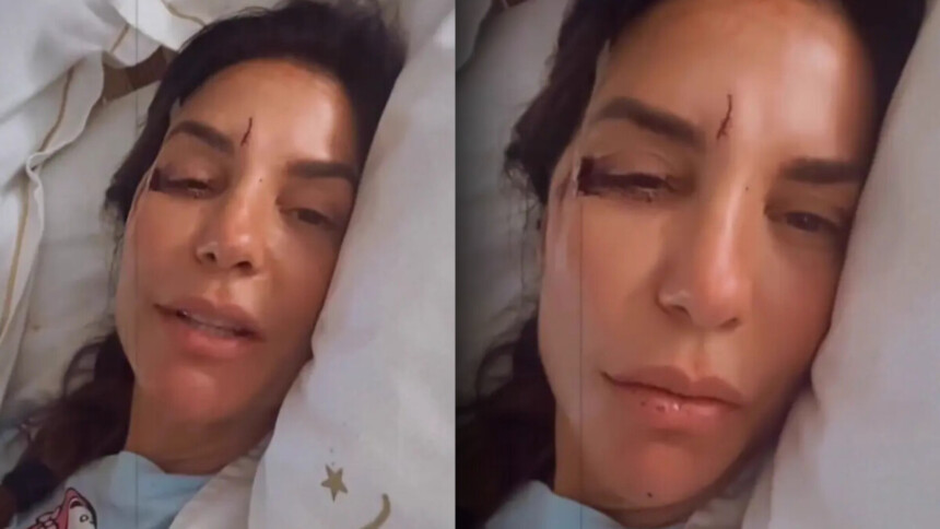 Ivete Sangalo deitada na maca de um hospital com o rosto apresentando machucões na lateral do olho esquerdo e na testa