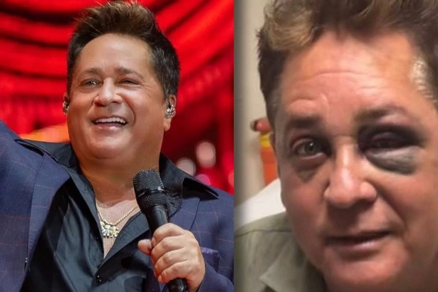 Cantor Leonardo, em trecho de show com montagem mostrando o olho rosto após o acidente