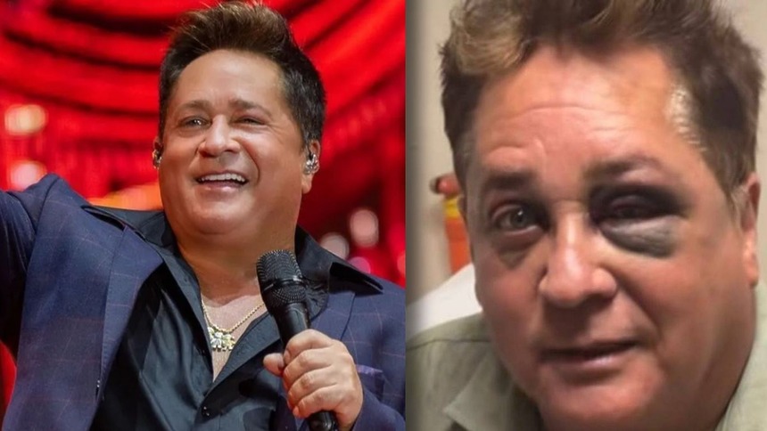 Cantor Leonardo, em trecho de show com montagem mostrando o olho rosto após o acidente