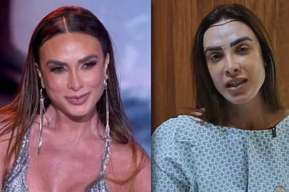 Nicole Bahls em uma montagem, com trecho de uma participação no Domingão e em trecho do procedimento no transplante capilar