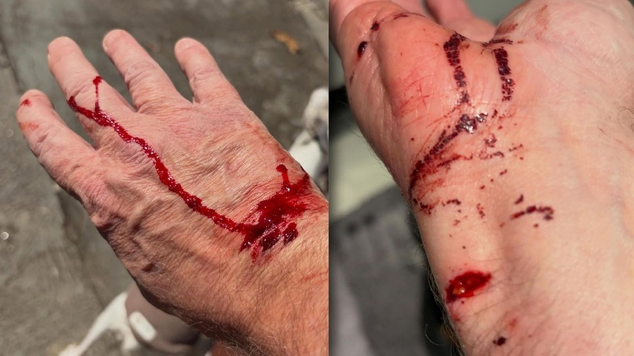 Burnier mostrando os ferimentos na mão e sangue, após ataque de pitbull 