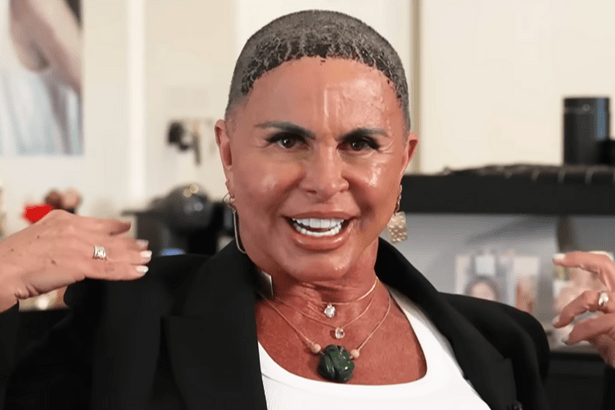 Gretchen sorridente, mas careca em entrevista ao Domingo Espetacular